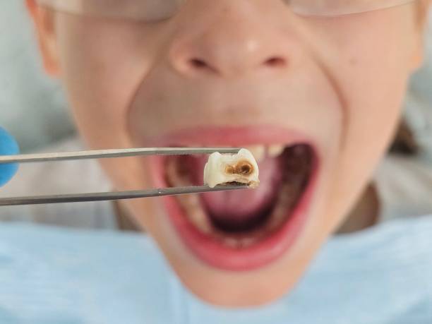Best Emergency Tooth Extraction in Sandy, UT