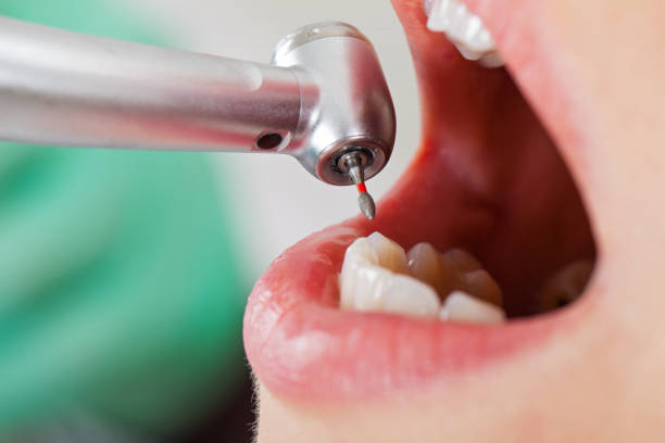 Best Emergency Root Canal Treatment in Sandy, UT